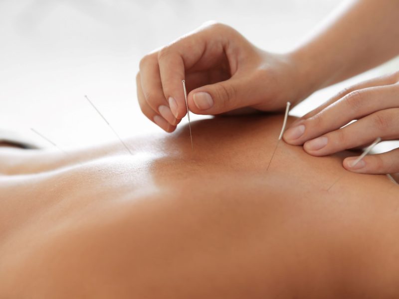 Akupunktur Schmerztherapie